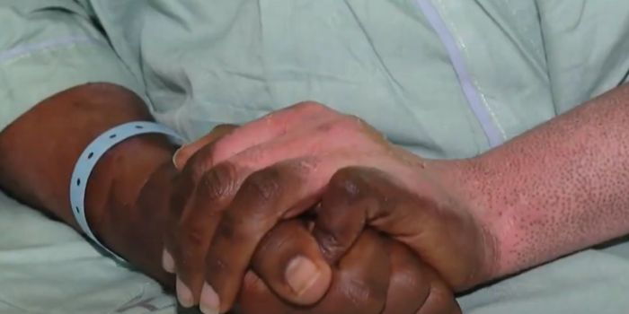 A screengrab of the hands of Nelly Wanjiku during an interview with NTV at Kenyatta National Hospital, Wednesday, September 12. Photo NTV